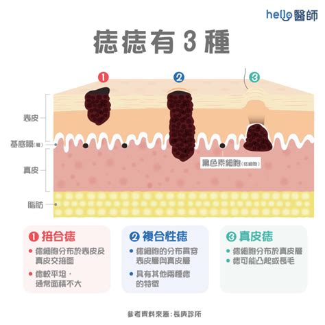 手臂長很多痣|痣變大、痣多或長毛會變皮膚癌？認識痣的形成與原因